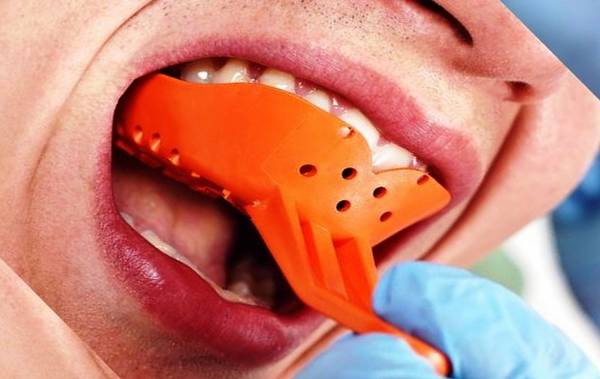  قالب گیری اسنپ اسمایل دندانپزشکی چگونه انجام می‌شود