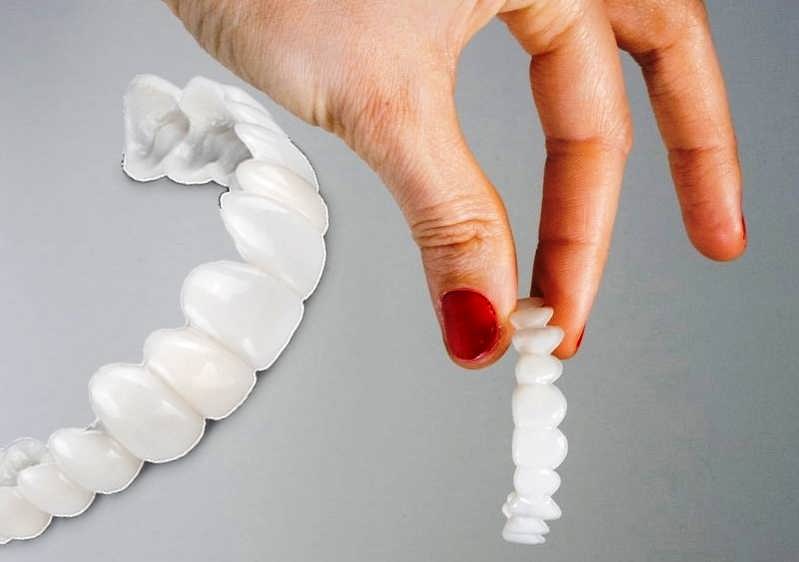 ظهور لمینت های دندانی تفاوت زیادی در زیبایی دندان ایجاد کرده است 