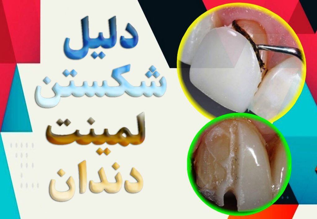 عامل اصلی و دلیل شکستن لمینت دندان